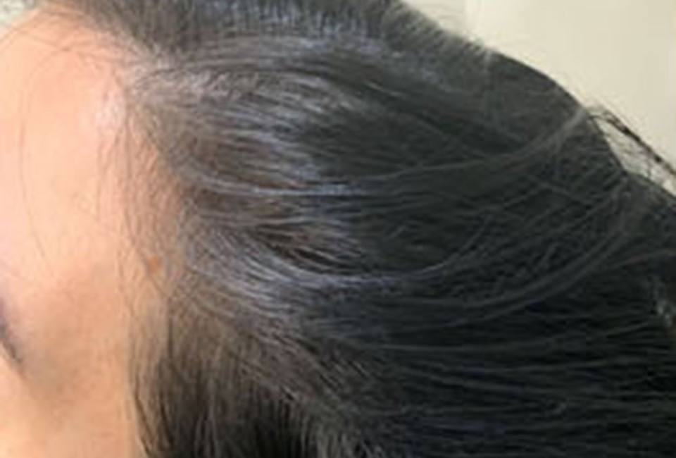 Scalp Micropigmentation & Hair Simulation in Atlanta – The Hair Simulation Company: hair growing