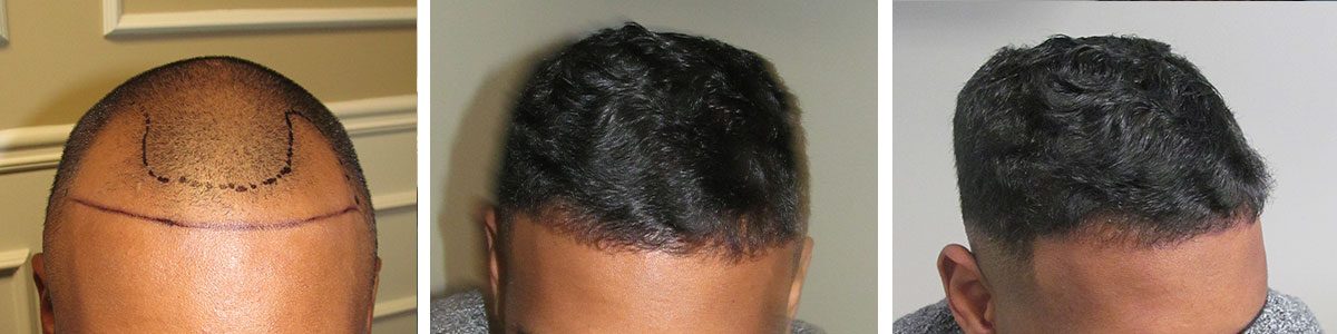 Hair transplant before and after from HRS Atlanta: a Black male patient’s hairline and top, before, with a marked hairline plan, and after