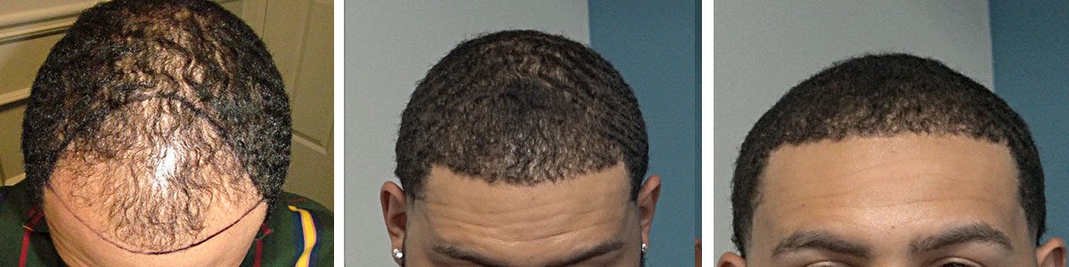 Hair transplant before and after from HRS Atlanta: a Black male patient’s crown and hairline before and after