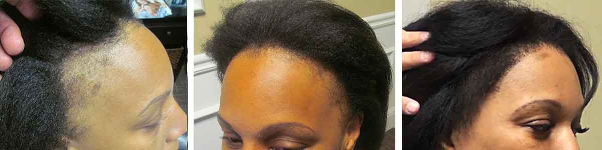 Hair transplant before and after from HRS Atlanta: a Black female patient’s hairline and temples before and after