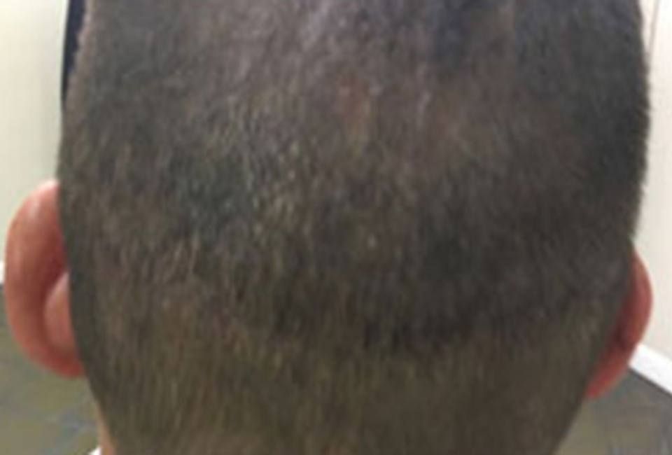Hair transplant and SMP planning for clients in Atlanta