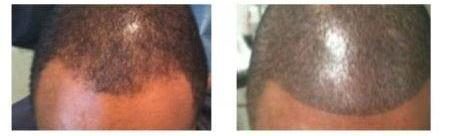 Before and after: SMP adding the look of density along the front hairline of a Black male client, by The Hair Simulation Co.