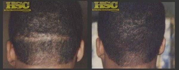 Before and after: scalp micropigmentation by The Hair Simulation Co. reducing the look of a linear hair transplant donor scar on a Black male client