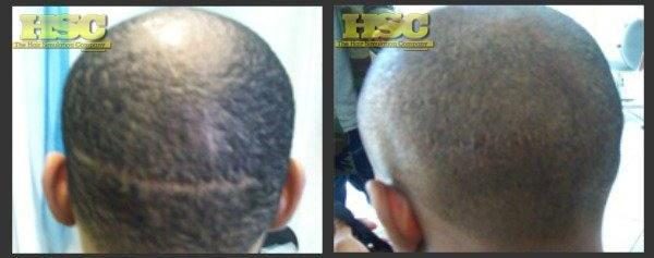 Before and after: SMP scar camouflage by The Hair Simulation Co. on a Black male client with a linear donor scar, buzz-cut length