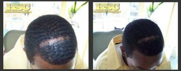 Before and after: SMP by The Hair Simulation Co. softening a scalp scar on a Black male client with waves