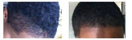 Before and after: women’s SMP by The Hair Simulation Co. filling in a thinning hairline on a client with Afro-textured hair