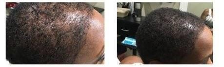 Before and after: women’s SMP by The Hair Simulation Co. reducing scalp show-through at the temple and side on Afro-textured hair