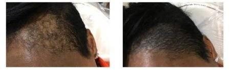 Before and after: women’s SMP by The Hair Simulation Co. at the temple and part area on textured hair