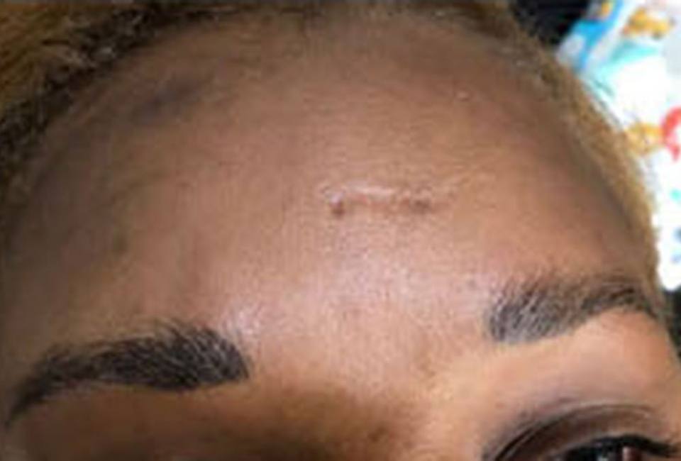 Scalp Micropigmentation & Hair Simulation in Atlanta – The Hair Simulation Company: Womens Brow