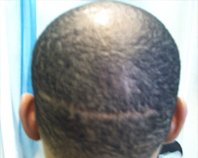 Benefits of “Artistic Hair Simulation on African American”|Scalp Aesthetics Treatment