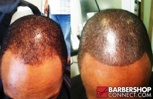 Cosmetic Tattoo Pigmentation|Scalp Micro Pigmentation| African American Hairline Solutions